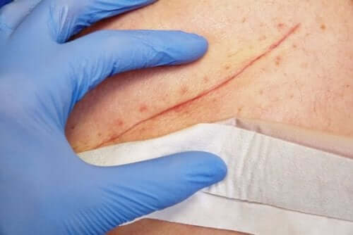 Technieken voor de behandeling van grote wonden
