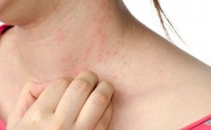 De symptomen van netelroos verlichten met natuurlijke remedies