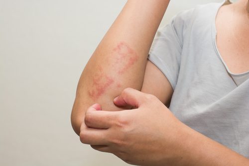 Iemand met psoriasis