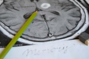 De symptomen en preventie van amnesie