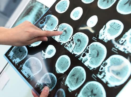 Ernstige neurocognitieve stoornis (dementie)