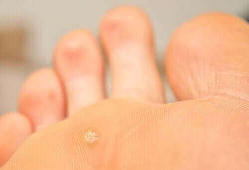 Diagnose van plantaire wratten