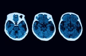 Diagnose van posterieure corticale atrofie