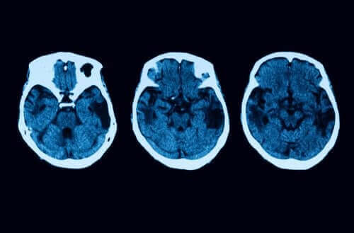 Diagnose van posterieure corticale atrofie