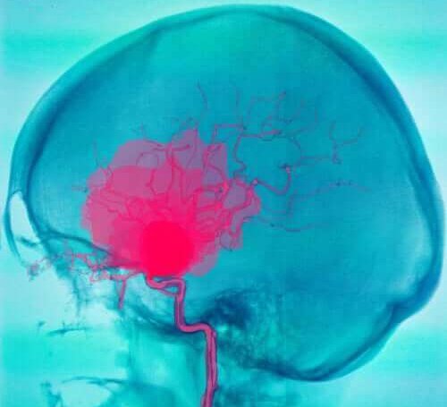 Symptomen van cerebrale parese