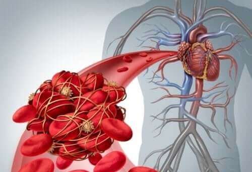 Wat veroorzaakt diepveneuze trombose