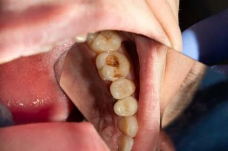 Tandbederf: wat veroorzaakt gaatjes in de tanden?