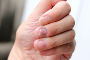 5 natuurlijke remedies voor nagelpsoriasis