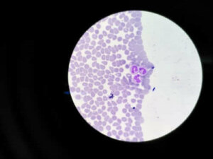 Agranulocytose: symptomen en behandelingen