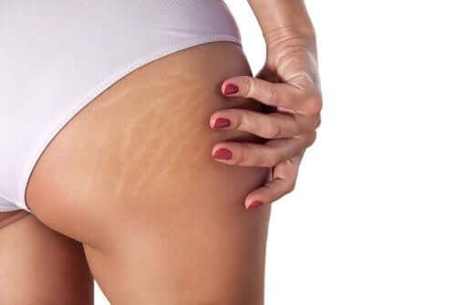 Huid met striae