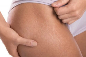 Zelfgemaakte zalf met vitamine E tegen striae