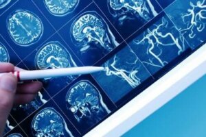 Wat is vasculaire dementie?