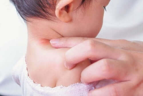 Een kindje met congenitale musculaire torticollis