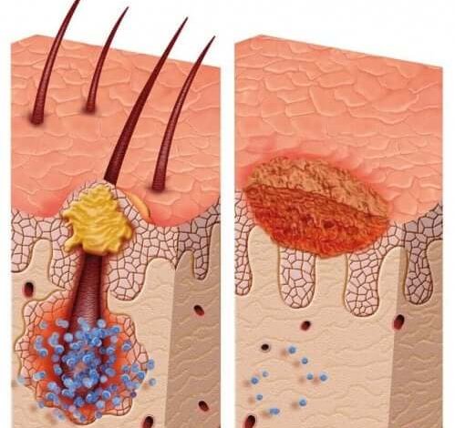 Wat is het meervoudig pilomatrixoma syndroom