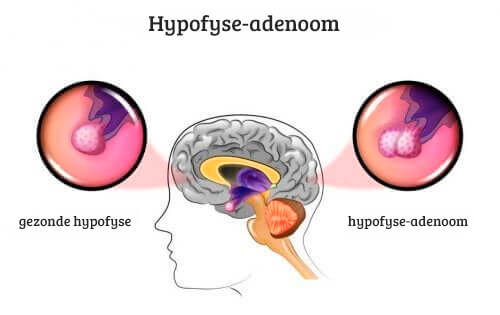 Hypofyse-adenomen: oorzaken en symptomen
