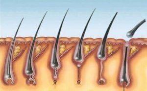 Het meervoudig pilomatrixoma syndroom
