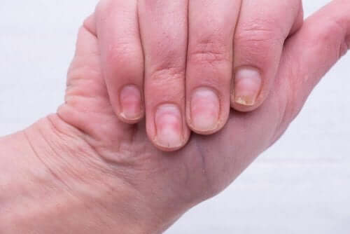 Natuurlijke remedies voor gele nagels