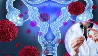 terapia del papilloma virus
