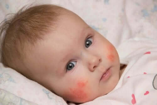 Kindje met huiduitslag in het gezicht