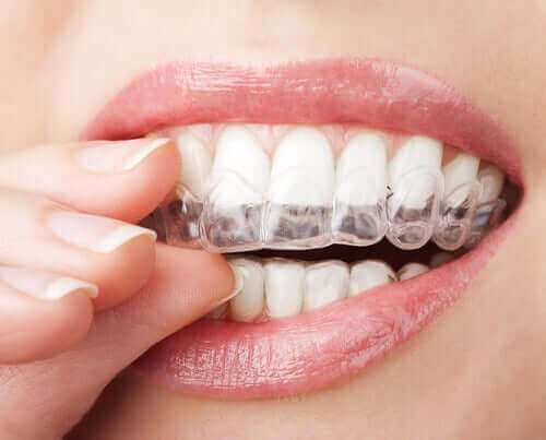 Doorzichtige aligners