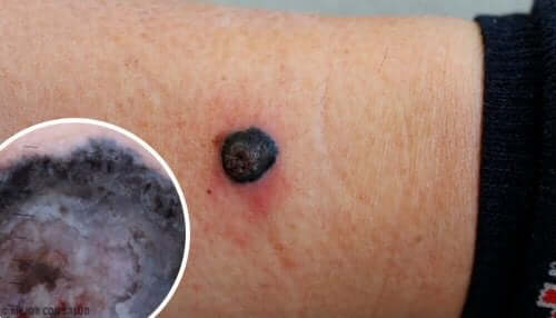 Wat is een kwaadaardig melanoom?
