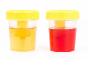 Hematurie: symptomen en oorzaken