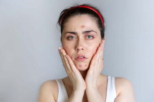Vrouw met acne