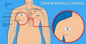 Vasculaire perforatie en centrale veneuze katheters