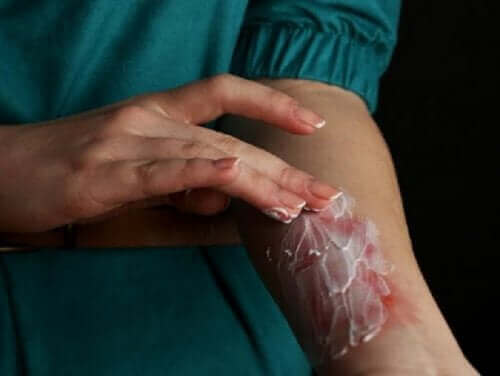 Eerste hulp voor een oppervlakkige brandwond