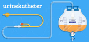 Behandeling van urineretentie na de bevalling