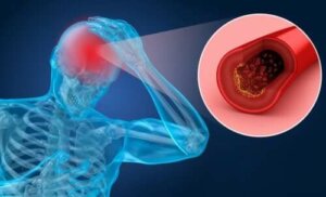 De risicofactoren en symptomen van een herseninfarct