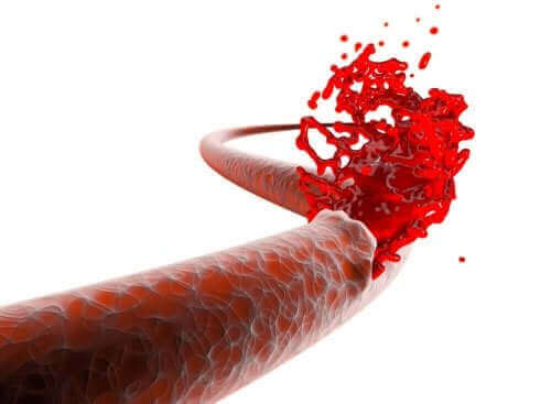 De risico's van postoperatieve bloedingen - Gezonder Leven