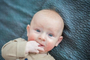Basisverzorging voor constitutioneel eczeem bij baby's