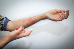 Hoe behandel je een oppervlakkige brandwond?