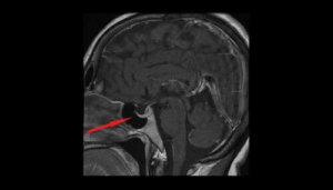 Wat is een hypofyse-adenoom?