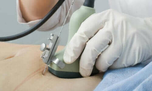 Diagnose van adenomyose