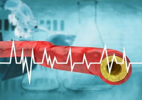 Doorsnede van een ader met te hoge cholesterol