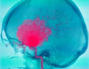 Subarachnoïdale en subdurale bloedingen