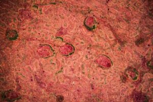 Diagnose en behandeling van niertuberculose