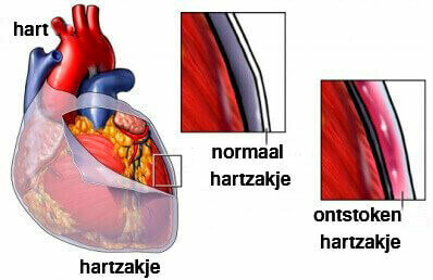 Een illustratie van een hart met pericarditis