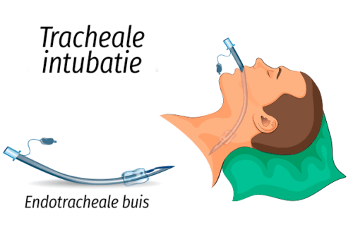 Intubatie