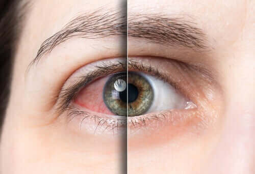 Rood oog en gezond oog