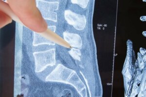 Radiculopathie: oorzaken, symptomen en behandeling
