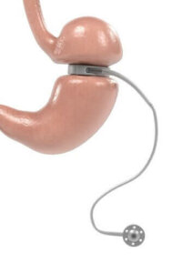 Gebruik en kenmerken van een verstelbare maagband