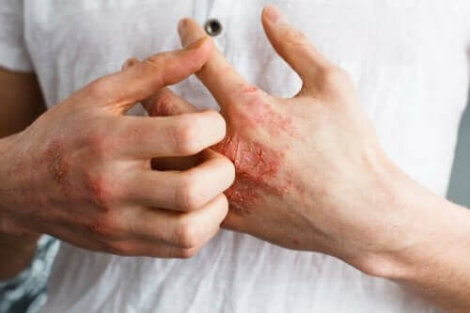 Wat is atopische dermatitis precies?