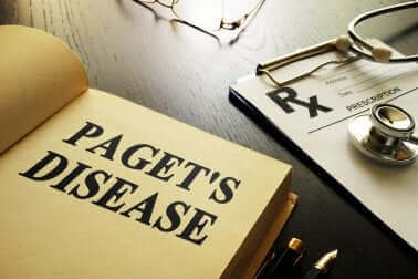 Ziekte van Paget: alles dat je moet weten