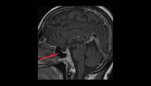 Röntgen van de schedel