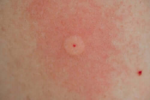 Steek van een insect op de huid