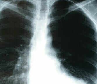 Röntgen van een longontsteking