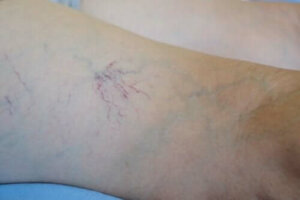 Venoruton - kenmerken en toepassingen